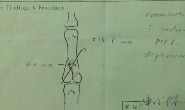 正顎,下巴後縮,雅丰,陳怡傑醫師,長庚正顎,戽斗,月亮臉,長下巴,牙套矯正